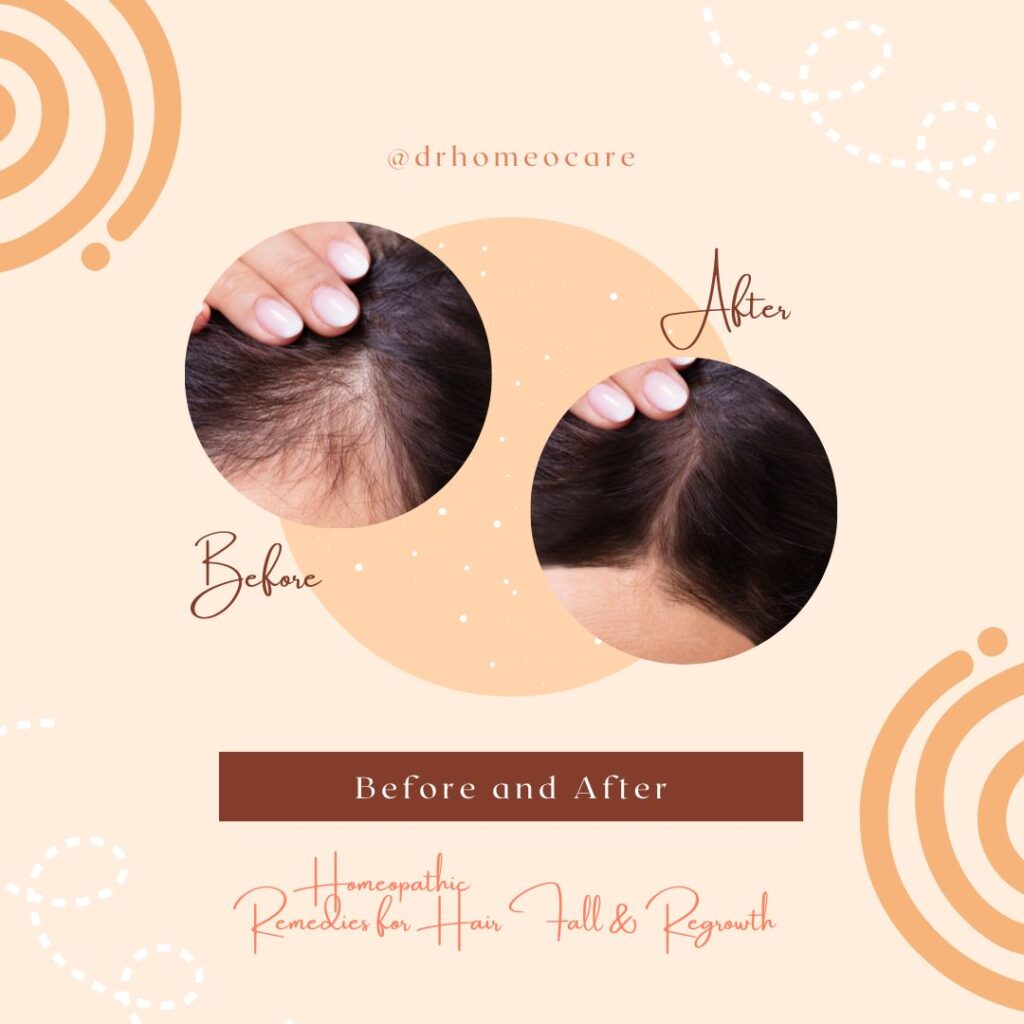 Homeopathic Remedies for Hair Fall & Regrowth